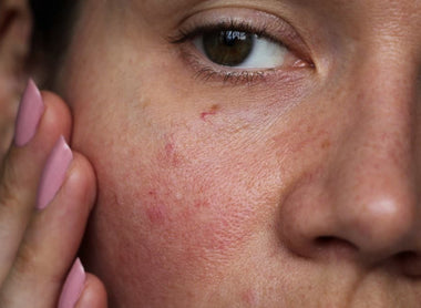 Sensitive Skin: How to Care for and Protect Delicate Skin from Irritation