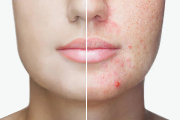 Pimples Are Caused by Dirty Skin