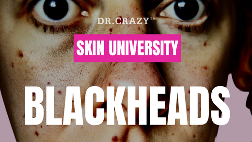 Blackheads: How to Effectively Remove and Prevent Them for Clearer Skin