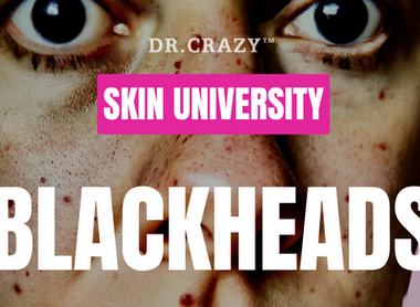 Blackheads: How to Effectively Remove and Prevent Them for Clearer Skin