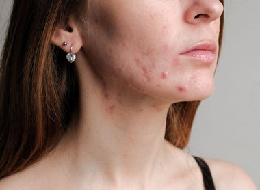 Acne: Your Ultimate Guide to Clear Skin & How to Banish Acne Scars