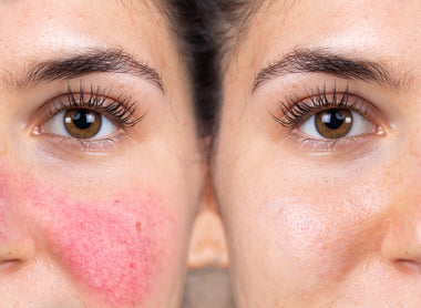 Rosacea: How to Manage Redness and Soothe Sensitive Skin