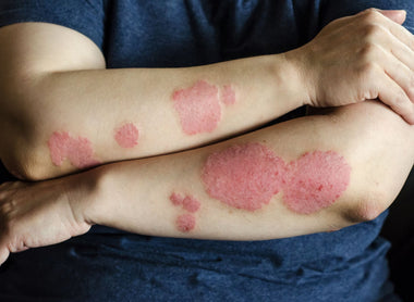 Psoriasis: How to Manage and Treat This Chronic Skin Condition