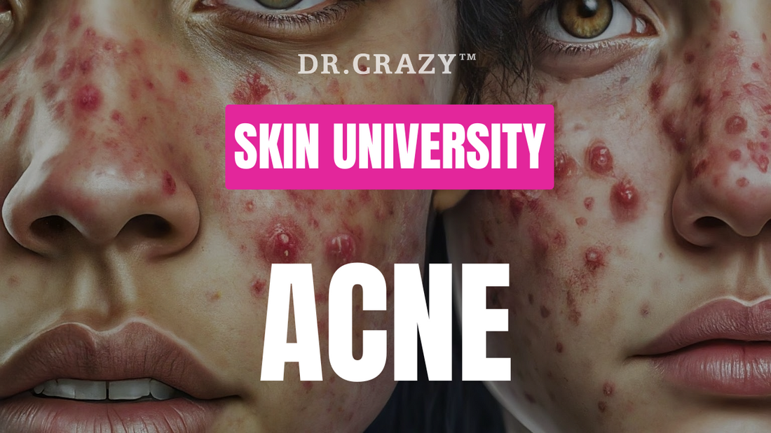 Acne: Your Ultimate Guide to Clear Skin & How to Banish Acne Scars