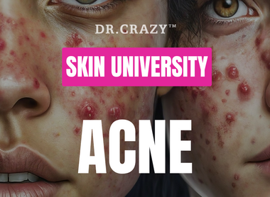 Acne: Your Ultimate Guide to Clear Skin & How to Banish Acne Scars