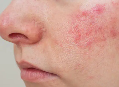 Eczema: Effective Treatments for Dry, Itchy Skin and How to Prevent Flare-Ups