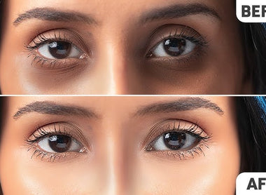 Dark Circles: How to Reduce Dark Circles Under Eyes and Brighten Your Skin