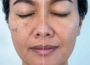 Melasma: How to Treat and Lighten Melasma for a Clearer Complexion