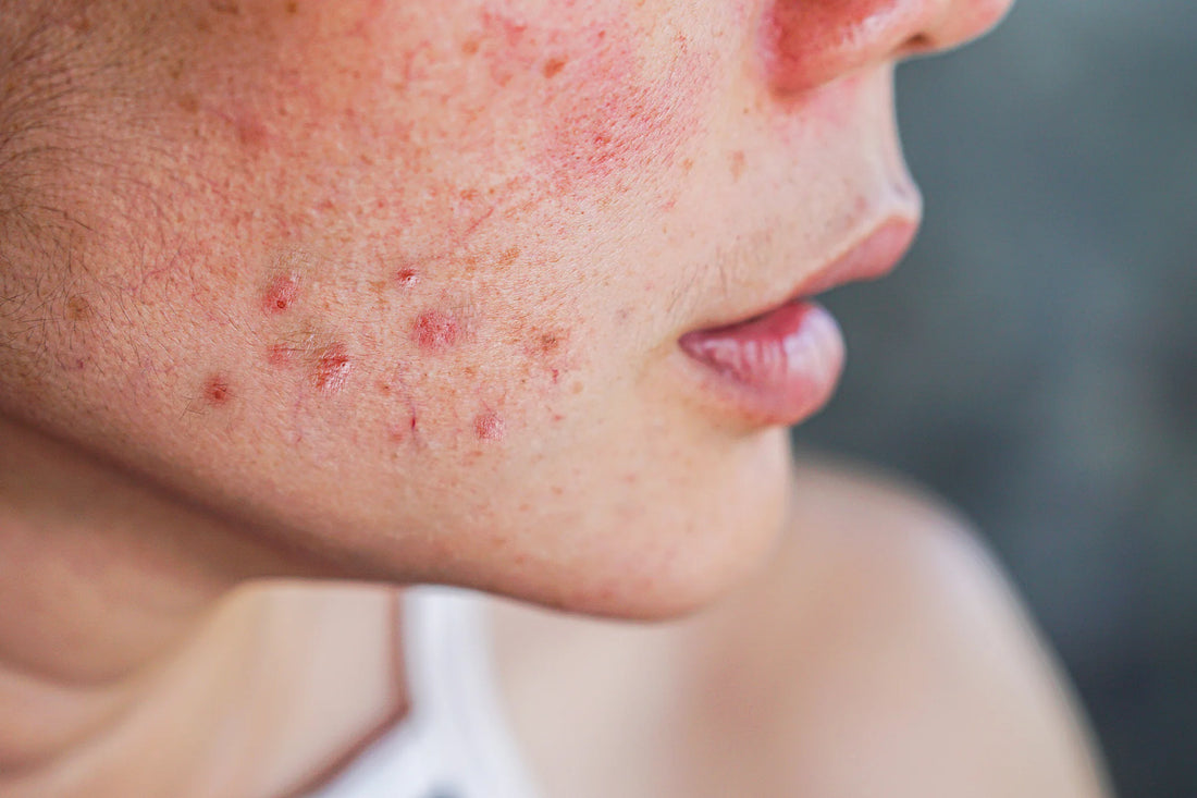 If You Have Acne, You Should Dry Out Your Skin